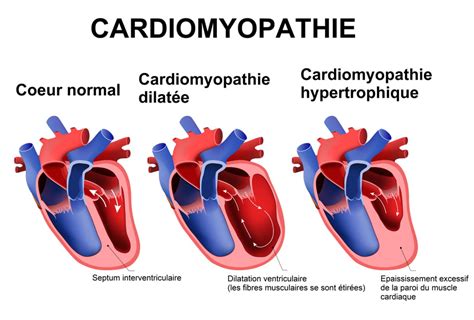 Cardiomyopathie .